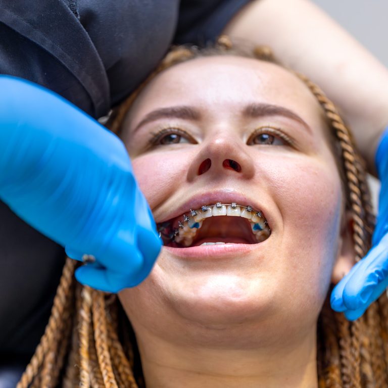 Dental procedure for installing braces close up. Dentistry. Braces on the teeth. High quality photo. Professional dental treatment. Doctor and patient.